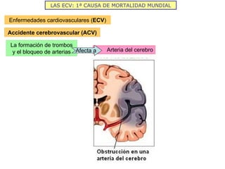 LAS ECV: 1ª CAUSA DE MORTALIDAD MUNDIAL Enfermedades cardiovasculares ( ECV ) Accidente cerebrovascular (ACV) La formación de trombos y el bloqueo de arterias Arteria del cerebro Afecta a 