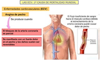 LAS ECV: 1ª CAUSA DE MORTALIDAD MUNDIAL Enfermedades cardiovasculares ( ECV ) Angina de pecho Se produce cuando El bloqueo de la arteria coronaria es parcial Se manifiesta con un fuerte dolor en el pecho y los daños suelen ser reversibles 