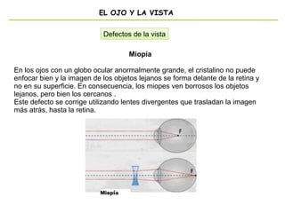 EL OJO Y LA VISTA
Miopía
En los ojos con un globo ocular anormalmente grande, el cristalino no puede
enfocar bien y la imagen de los objetos lejanos se forma delante de la retina y
no en su superficie. En consecuencia, los miopes ven borrosos los objetos
lejanos, pero bien los cercanos .
Este defecto se corrige utilizando lentes divergentes que trasladan la imagen
más atrás, hasta la retina.
Defectos de la vista
 