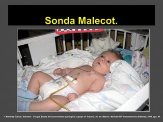 1. Martínez Dubois, Salvador. Cirugía. Bases del conocimiento quirúrgico y apoyo en Trauma. 5ta ed. México: McGraw-Hill Interamericana Editores; 2005. pgs. 80.
 