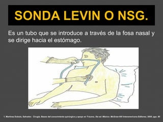 1. Martínez Dubois, Salvador. Cirugía. Bases del conocimiento quirúrgico y apoyo en Trauma. 5ta ed. México: McGraw-Hill Interamericana Editores; 2005. pgs. 80
Es un tubo que se introduce a través de la fosa nasal y
se dirige hacia el estómago.
 