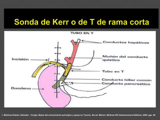 1. Martínez Dubois, Salvador. Cirugía. Bases del conocimiento quirúrgico y apoyo en Trauma. 5ta ed. México: McGraw-Hill Interamericana Editores; 2005. pgs. 80.
 