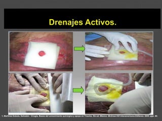 1. Martínez Dubois, Salvador. Cirugía. Bases del conocimiento quirúrgico y apoyo en Trauma. 5ta ed. México: McGraw-Hill Interamericana Editores; 2005. pgs. 80.
 