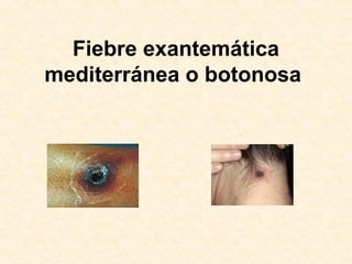 Fiebre exantemática
mediterránea o botonosa
 