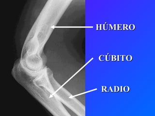 HÚMERO CÚBITO RADIO 