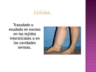 Trasudado o
exudado en exceso
  en los tejidos
intersticiales o en
   las cavidades
      serosas.
 