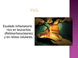 Exudado inflamatorio
   rico en leucocitos
 (Polimorfonucleares)
 y en restos celulares.
 