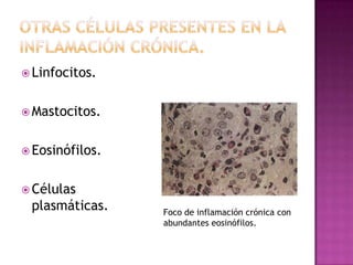  Linfocitos.


 Mastocitos.


 Eosinófilos.


 Células
 plasmáticas.    Foco de inflamación crónica con
                 abundantes eosinófilos.
 