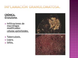 CRÓNICA.
Granuloma.

   Infiltraciones de
    macrófagos
    modificados:
    células epitelioides.

   Tuberculosis.
   Lepra.
   Sífilis.
 