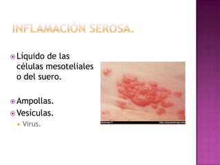  Líquidode las
 células mesoteliales
 o del suero.

 Ampollas.
 Vesículas.
    Virus.
 