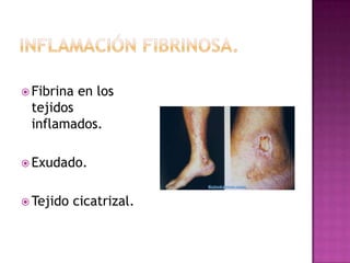  Fibrina   en los
 tejidos
 inflamados.

 Exudado.


 Tejido   cicatrizal.
 