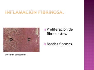  Proliferación   de
                        fibroblastos.

                        Bandas   fibrosas.

Corte en pericardio.
 