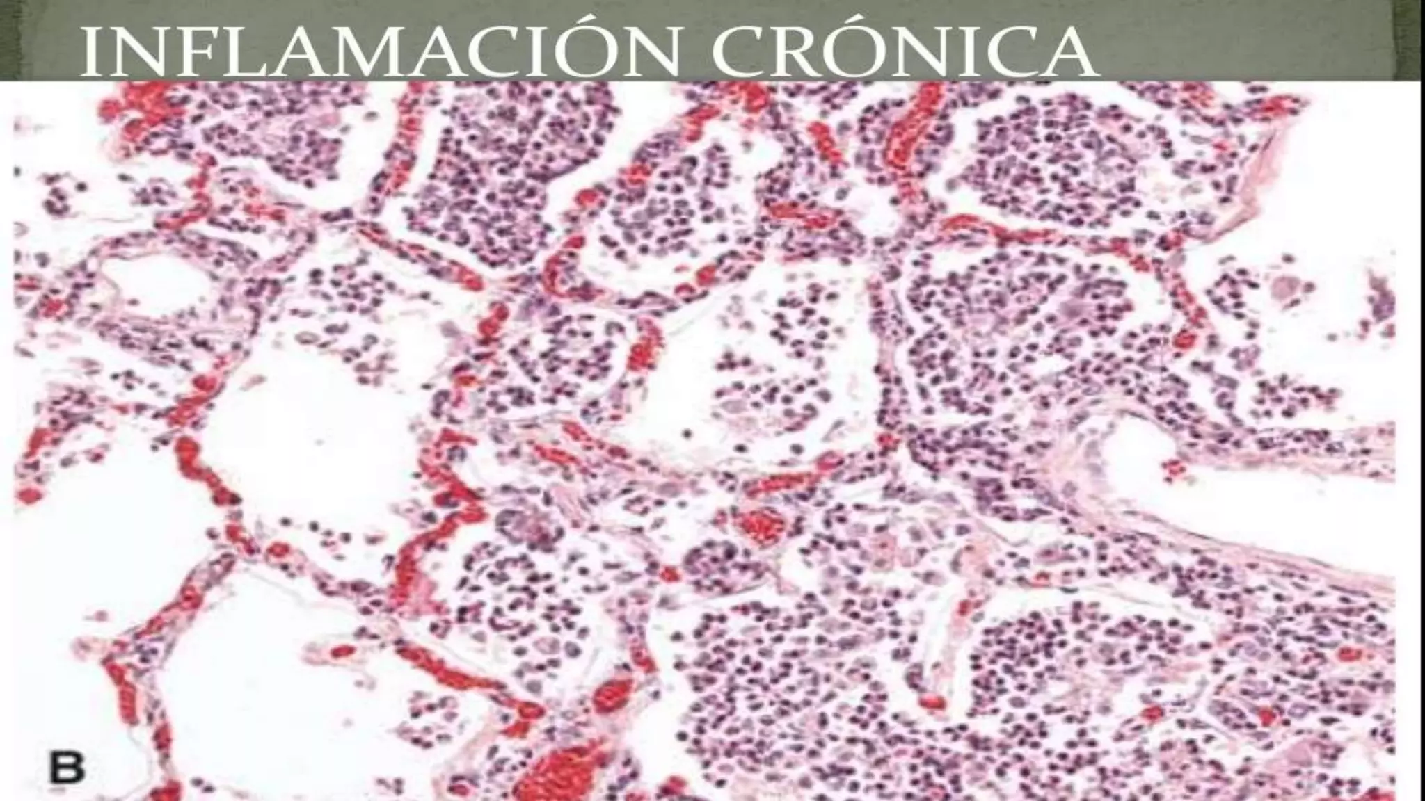 Inflamacion Aguda Y Cronica PPTX inflamacion-aguda-y-cronica-pptx