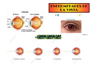 ENFERMEDADES DE
LA VISTA
defectos en la visión
 
