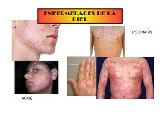 ENFERMEDADES DE LA
PIEL
ACNÉ
PSORIASIS
 