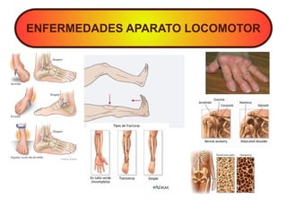 ENFERMEDADES APARATO LOCOMOTOR
 