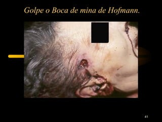 Golpe o Boca de mina de Hofmann.




                                   41
 