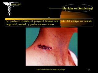 Armas de Fuego


                                                        Heridas en Semicanal


Se producen cuando el proyectil lesiona una parte del cuerpo en sentido
tangencial, rozando y produciendo un surco.




                         Roce de Proyectil de Arma de Fuego             47
 