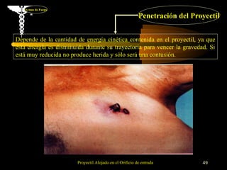 Armas de Fuego

                                                         Penetración del Proyectil


Depende de la cantidad de energía cinética contenida en el proyectil, ya que
ésta energía es disminuida durante su trayectoria para vencer la gravedad. Si
está muy reducida no produce herida y sólo será una contusión.




                       Proyectil Alojado en el Orificio de entrada          49
 