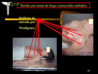 Armas de Fuego
                 Heridas por armas de fuego a proyectiles múltiples


             Orificios de
             entrada por
                 Perdigones




                                                                      60
 