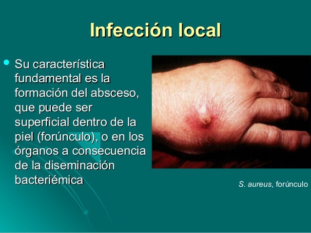 Asd la fracción como aceptar a la eccema