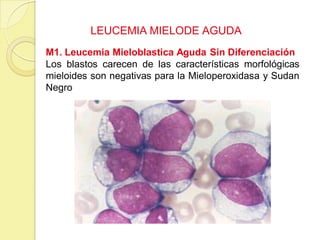 LEUCEMIA MIELODE AGUDA
M1. Leucemia Mieloblastica Aguda Sin Diferenciación
Los blastos carecen de las características morfológicas
mieloides son negativas para la Mieloperoxidasa y Sudan
Negro
 