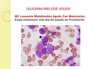 LEUCEMIA MIELODE AGUDA
M2. Leucemia Mieloblastica Aguda Con Maduración
Existe maduración más allá del estadio de Promielocito
 