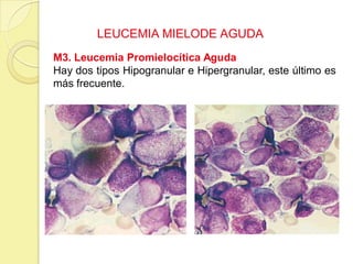 LEUCEMIA MIELODE AGUDA
M3. Leucemia Promielocítica Aguda
Hay dos tipos Hipogranular e Hipergranular, este último es
más frecuente.
 