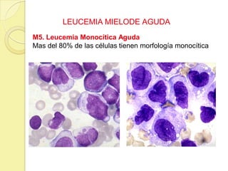 LEUCEMIA MIELODE AGUDA
M5. Leucemia Monocítica Aguda
Mas del 80% de las células tienen morfología monocítica
 