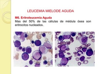LEUCEMIA MIELODE AGUDA
M6. Eritroleucemia Aguda
Mas del 50% de las células de médula ósea son
eritrocitos nucleados.
 