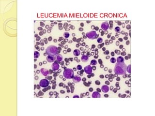 LEUCEMIA MIELOIDE CRONICA
 