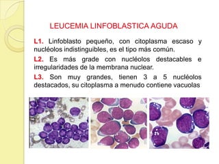 LEUCEMIA LINFOBLASTICA AGUDA
L1. Linfoblasto pequeño, con citoplasma escaso y
nucléolos indistinguibles, es el tipo más común.
L2. Es más grade con nucléolos destacables e
irregularidades de la membrana nuclear.
L3. Son muy grandes, tienen 3 a 5 nucléolos
destacados, su citoplasma a menudo contiene vacuolas
 