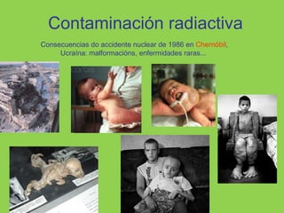 Contaminación radiactiva
Consecuencias do accidente nuclear de 1986 en Chernóbil,
Ucraína: malformacións, enfermidades raras...
 