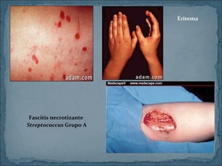 Eritema

Fascitis necrotizante
Streptococcus Grupo A

 