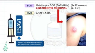 Esabi ESAVI- curso de inmunizaciones- enfermeria | PPTX