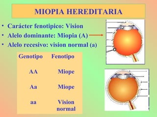 MIOPIA HEREDITARIA
• Carácter fenotipico: Vision
• Alelo dominante: Miopia (A)
• Alelo recesivo: vision normal (a)
Genotipo Fenotipo
AA Miope
Aa Miope
aa Vision
normal
 
