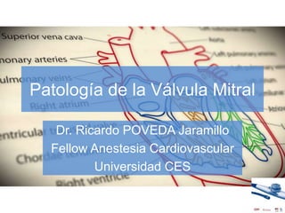 Patología de la Válvula Mitral
Dr. Ricardo POVEDA Jaramillo
Fellow Anestesia Cardiovascular
Universidad CES
 