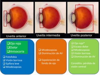  Fotofobia
 Visión borrosa
 Epífora leve
 Miodesopsias
 Miodesopsias
 Disminución de AV
 Expoloración de
fondo de ojo
Ojo rojo
Dolor
Anisocoria
 Ojo rojo*
 Escaso dolor
 Miodesopsias
 Visión borrosa
 Disminución de AV
Coroiditis: pérdida de
visión central
 