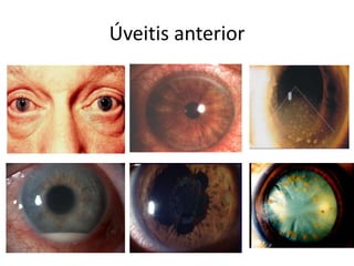 Úveitis anterior
 