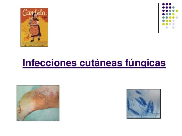 El hongo de las uñas el ungüento más barato