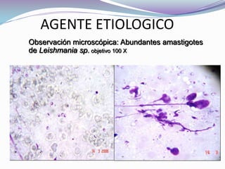         AGENTE ETIOLOGICOObservación microscópica: Abundantes amastigotes de Leishmania sp. objetivo 100 X