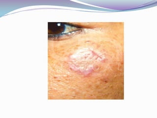 LEISHMANIASIS TEGUMENTARIA AMERICANA Celulas histiocitarias que son remplazadas por una de tipo granulomatosa, con  aumento de linfocitos y células plasmáticas ,células epiteloides y células gigantes de Langherhans.En el caso de las lesiones mucosas , estas se caracterizan por una reacción  granulomatosa necrotizante y con pocos parásitos ,las células inflamatorias mas abundantes son:  las células plasmáticas y linfáticas .La destrucción de la mucosa de la orofaringe lleva a la perdida de cartílago. 