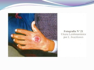 LEISHMANIASIS TEGUMENTARIA AMERICANA SINTOMATOLOGIA :La lesión cutánea típica es la ulcera. La lesión se inicia como una macula eritematosa que luego se convierte en pápula o pústula ,cuya base es firme e indurada, que crece lentamente para luego ulcerarse , se forma una costra ,debajo de la costra , la lesión se extiende en superficie y profundidad .