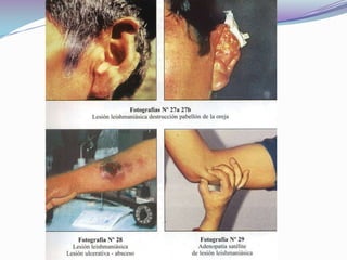        SINTOMATOLOGIAEVOLUCION CLINICA (Boletín informativo de CENETROP) La lesión inicial es muy pruriginosa que obliga a la fricción o rascado ,va evolucionando por las diferentes etapas de : eritema, macula, pápula ,vesícula ,pústula y ulceración ,esta ultima es dolorosa, la cual va creciendo y drenando .con la aplicación de antisépticos locales muchas lesiones no mejoran y al contrario evolucionan desfavorablemente.