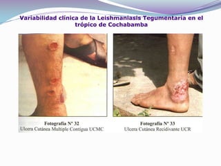         SINTOMATOLOGIAPor lo general están lesiones crecen en profundidad y extensión : la ulcera en esta etapa es muy húmeda, con abundante secreción serosa o serosanguinolenta, cuando no hay infección se presenta un dolor ,los bordes de la ulcera se tornan duros y acartonados ,en forma de sacabocados característicos , estos bordes se levantan con facilidad.En esta etapa de  la evolución , el tamaño de la ulcera oscila entre 2 a 3 cm , disminuye la sensibilidad al dolor ha disminuido y presenta bordes pálidos o cianóticos .