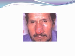 LEIHSMANIASIS CUTANEO-MUCOSADespués de un periodo de latencia ,las lesiones mucosas pueden situarse en la mucosa del tabique nasal ,en la rinofaringe y también la laringe.En caso de lesiones del tabique nasal se ha podido observan síntomas subjetivos tales como : prurito nasal , obstrucción nasal , y como síntomas subjetivos ,tumefacción inflamación , y congestión . Frecuentemente el paciente presenta epistaxis.