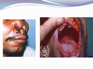     LEIHSMANIASIS CUTANEO-MUCOSAEn etapas avanzadas, se aprecia franca atrofia de la mucosa, la misma se recubre de costras secas que al quitarlas se puede ver una región pálida .Lo que mas llama la atención es la destrucción del tabique ya que no tarda en perforarse completamente dando como resultado deformaciones  de la nariz comúnmente conocida con el nombre de : nariz de tapìr 