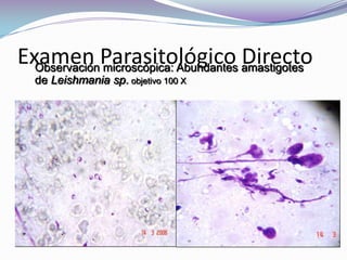 Examen Parasitológico DirectoObservación microscópica: Abundantes amastigotes de Leishmania sp. objetivo 100 X