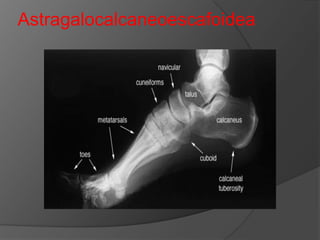 Astragalocalcaneoescafoidea

 