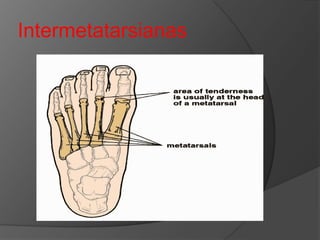 Intermetatarsianas

 
